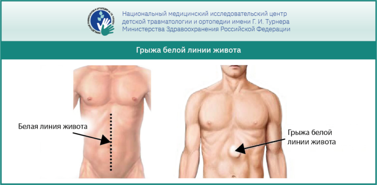 Грыжа белой линии живота у детей