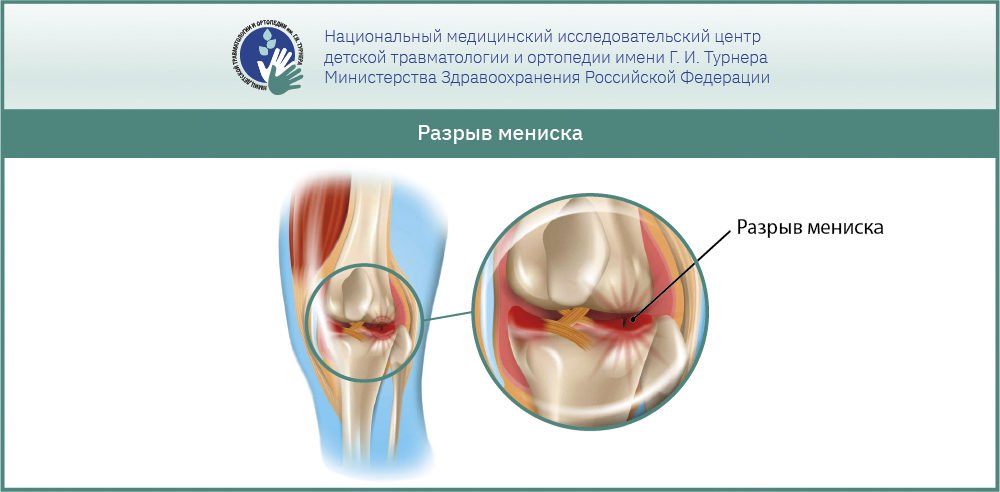 Повреждение мениска коленного сустава - лечение и операция в Москве