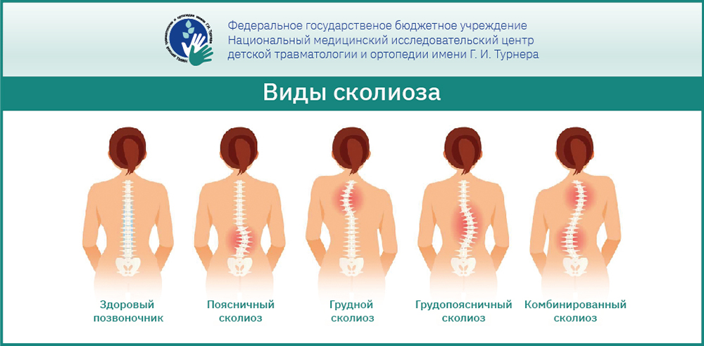 Опасные мифы о сколиозе, в которые пора перестать верить