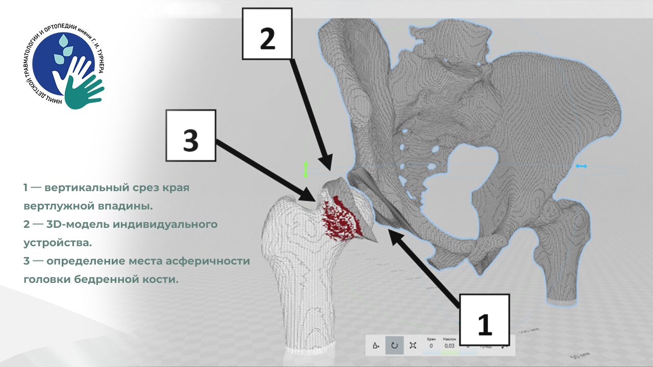 Персонализированная медицина нового уровня: в НМИЦ имени Г. И. Турнера начали использовать индивидуальные 3D-шаблоны для точной коррекции постишемических деформаций головки бедренной кости у детей